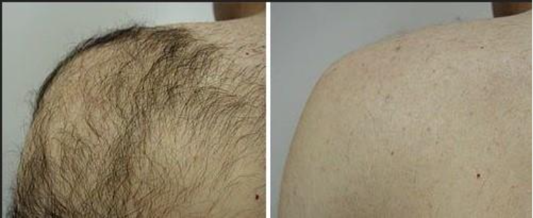 Laser Hair Removal