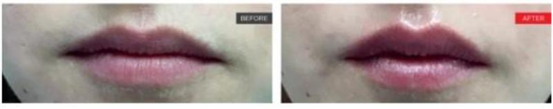 LipLase-Laser-Lip-Plumping