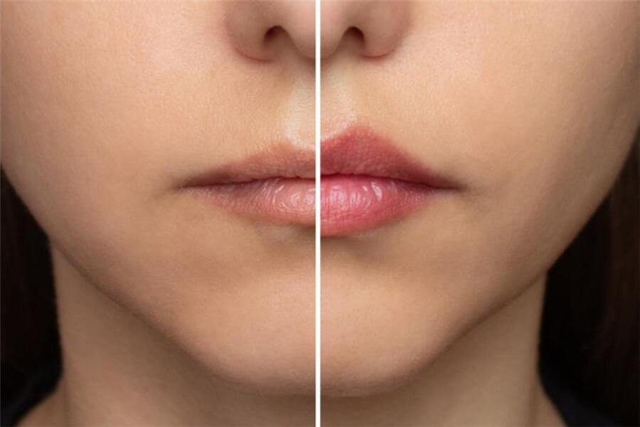 LipLase-Laser-Lip-Plumping Before and After