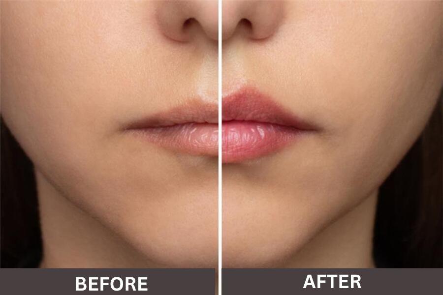 LipLase-Laser-Lip-Plumping Before and After